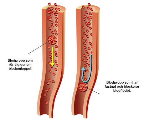 Blodproppar blodomloppet