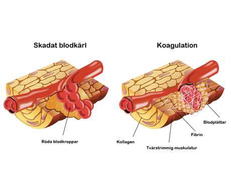 koagulation blodkärl