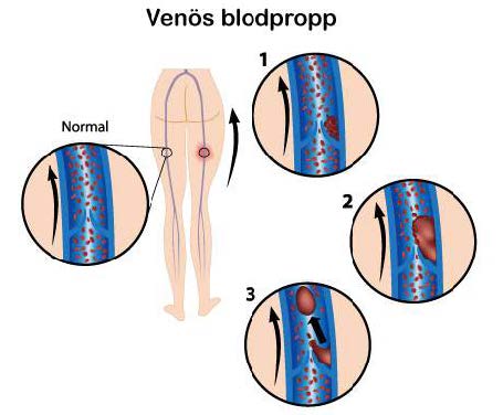 Venös blodpropp