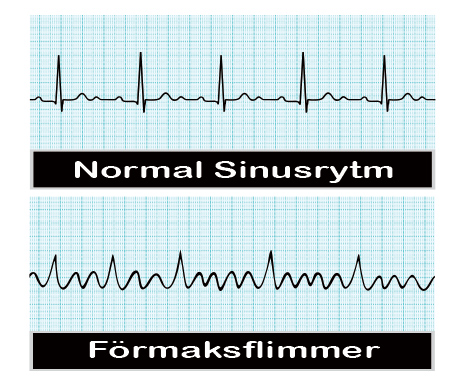 Sinusrytm förmaksflimmer 